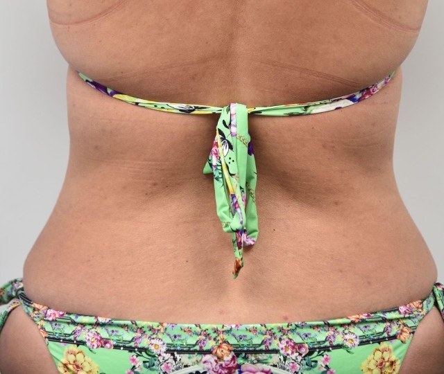 After abdominoplasty showing a flatter, smoother abdominal contour, posterior view