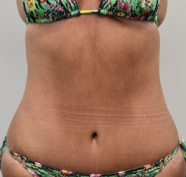After abdominoplasty showing a flatter, smoother abdominal contour, front view