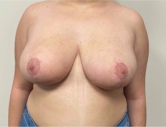 After breast reduction showing a lighter, more proportionate breast shape, front view