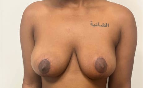 After breast reduction showing a lighter, more proportionate breast shape, front view