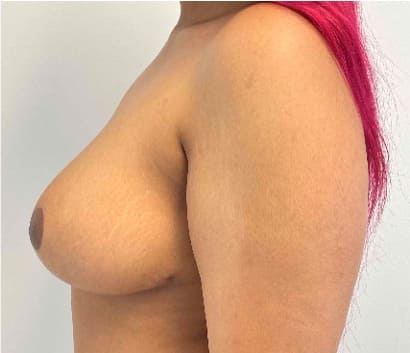 After breast reduction showing a lighter, more proportionate breast shape, left side view