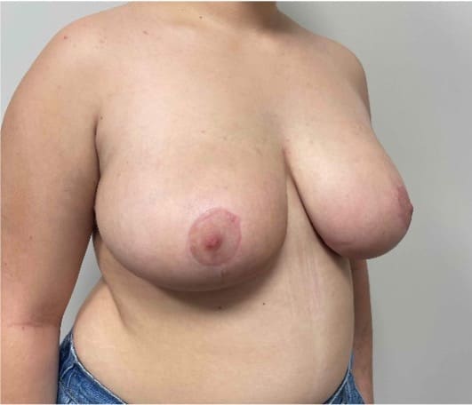 After breast reduction showing a lighter, more proportionate breast shape, right oblique view