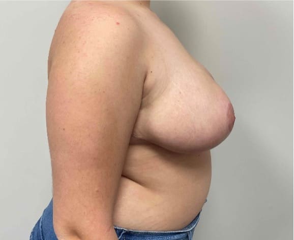 After breast reduction showing a lighter, more proportionate breast shape, right side view