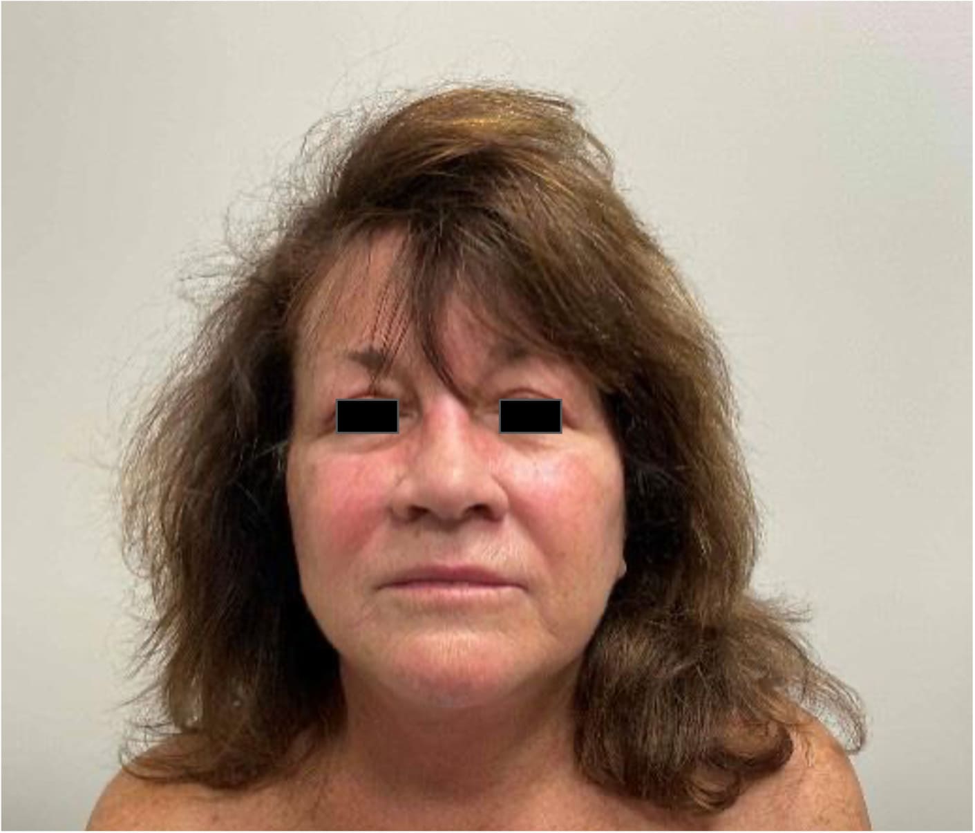 After face and neck lift with blepharoplasty showing a refreshed face, improved neck contour, and rejuvenated eye area, front view