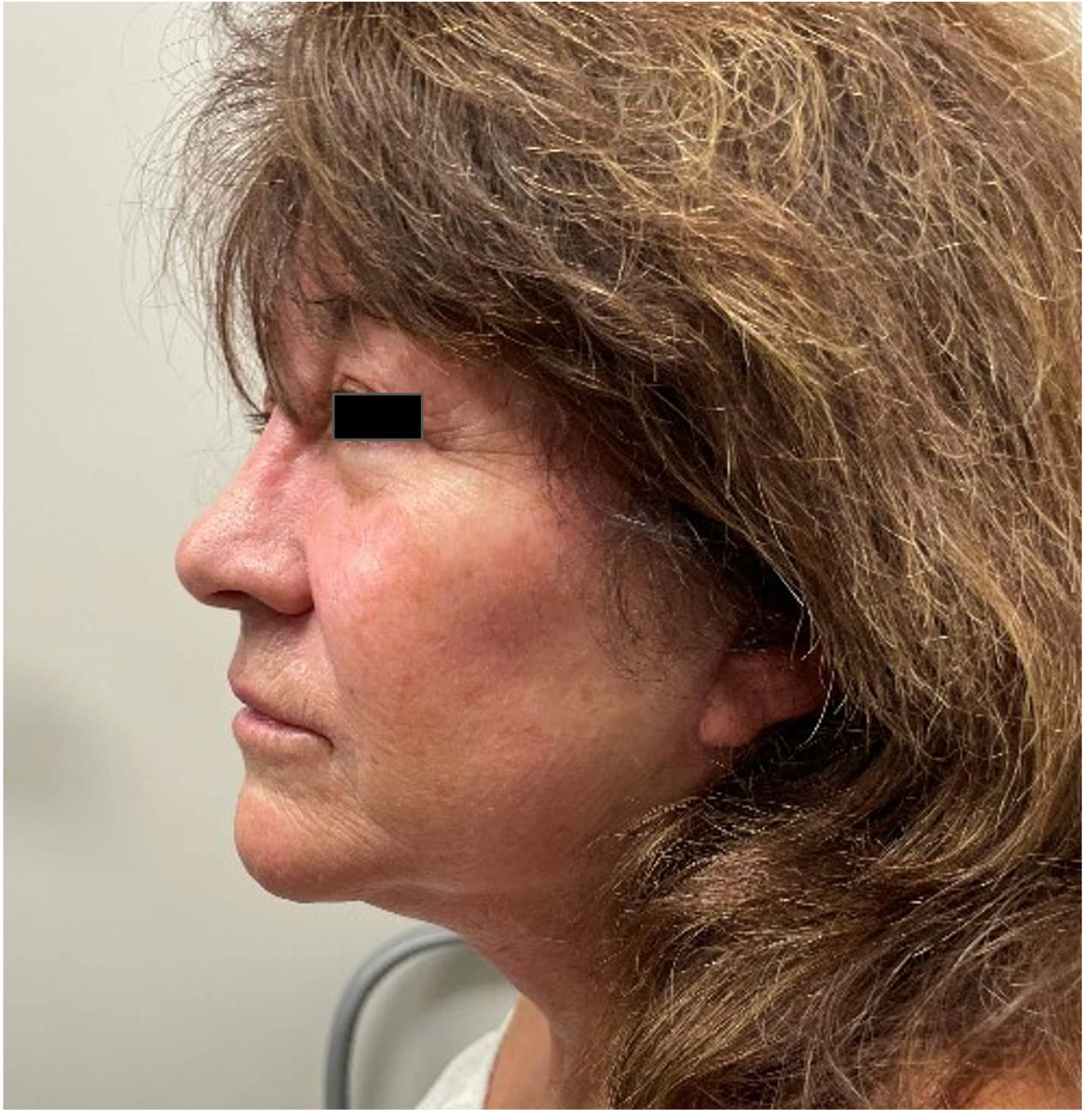 After face and neck lift with blepharoplasty showing a refreshed face, improved neck contour, and rejuvenated eye area, left oblique view