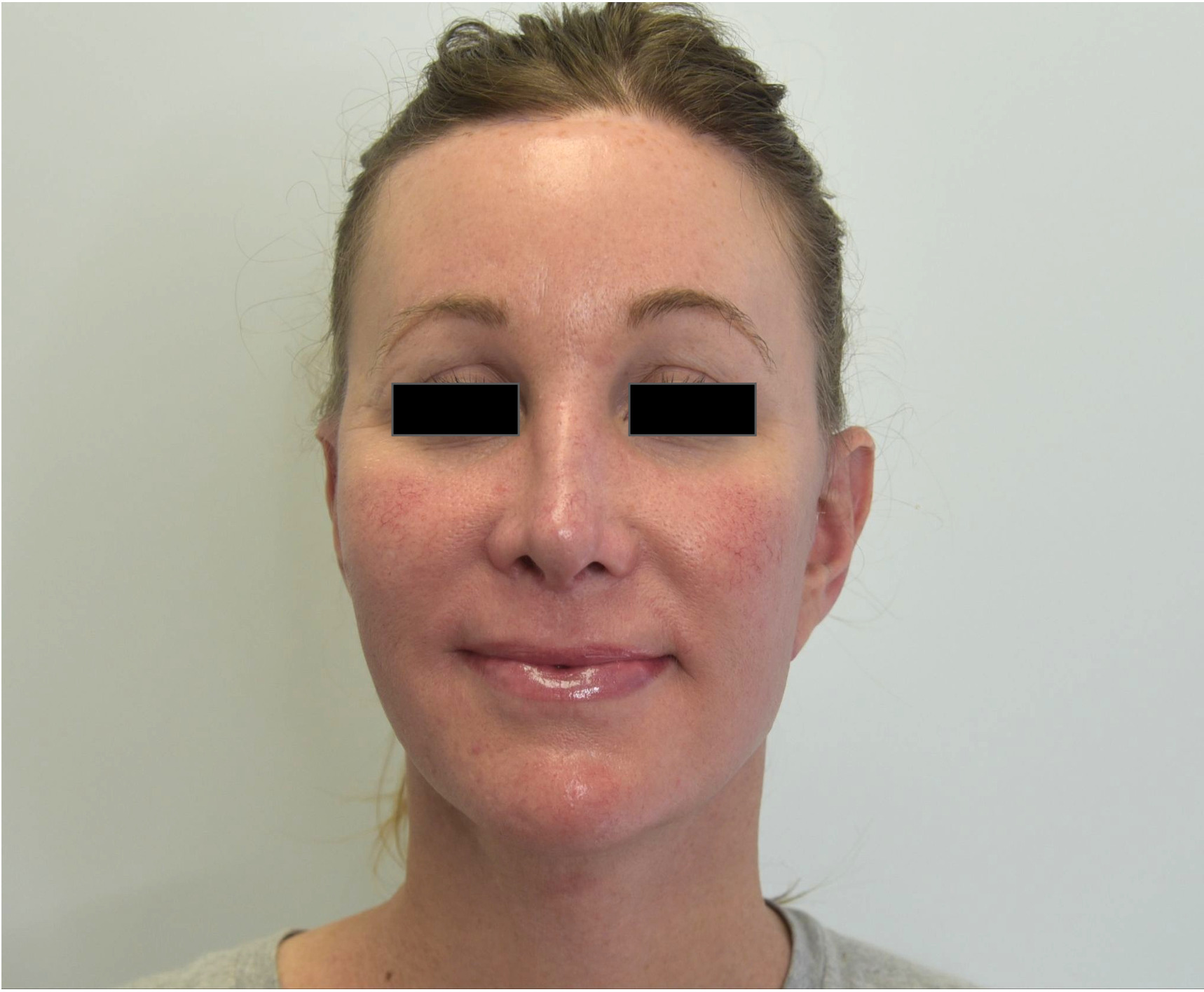 After face and neck lift showing a smoother jawline, improved neck contour and lifted cheeks, front view