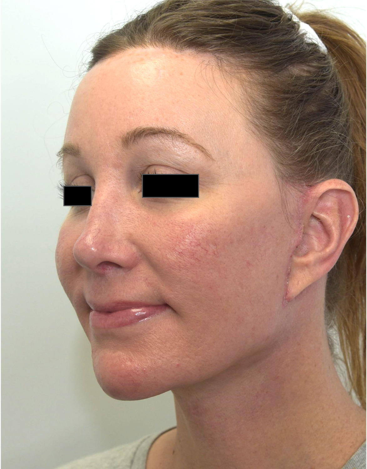 After face and neck lift showing a smoother jawline, improved neck contour and lifted cheeks, left oblique view