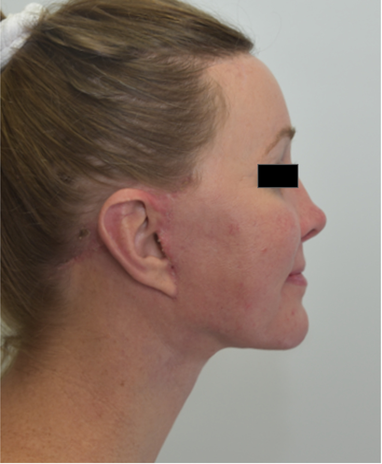 After face and neck lift showing a smoother jawline, improved neck contour and lifted cheeks, right side view