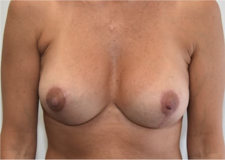 After implant exchange with axillary liposuction showing refined breast shape and improved upper outer chest contour with a smaller, more natural profile, front view
