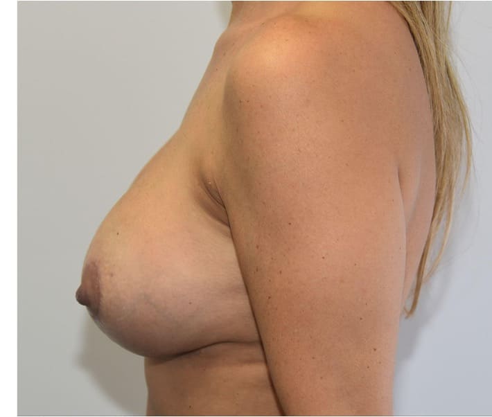 After implant exchange with axillary liposuction showing refined breast shape and improved upper outer chest contour with a smaller, more natural profile, left side view