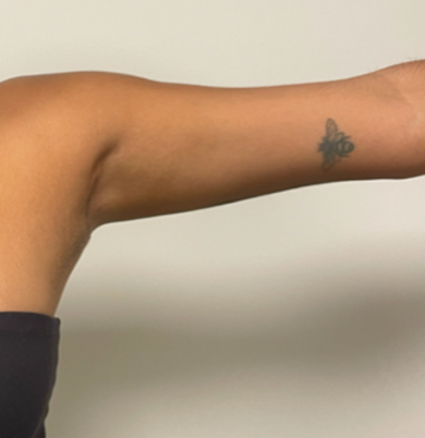 After left axillary breast tissue removal showing a smoother natural axillary contour with minimal scarring.