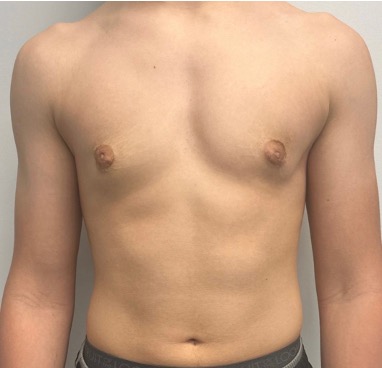 After male gynecomastia surgery showing a flatter, more defined chest contour.
