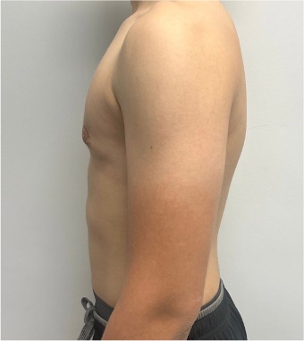 After male gynecomastia surgery showing excess breast tissue and a less defined chest contour