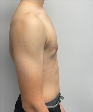 after male gynecomastia surgery showing a flatter, more defined chest contour.