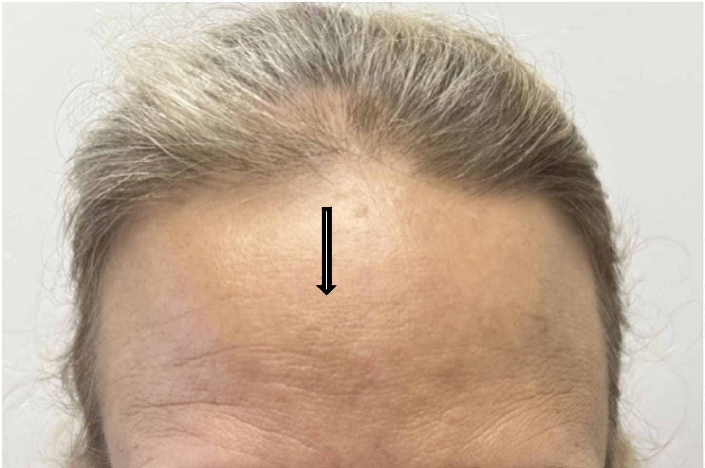 After osteoma removal showing a smoother forehead contour with a well-concealed incision, front view