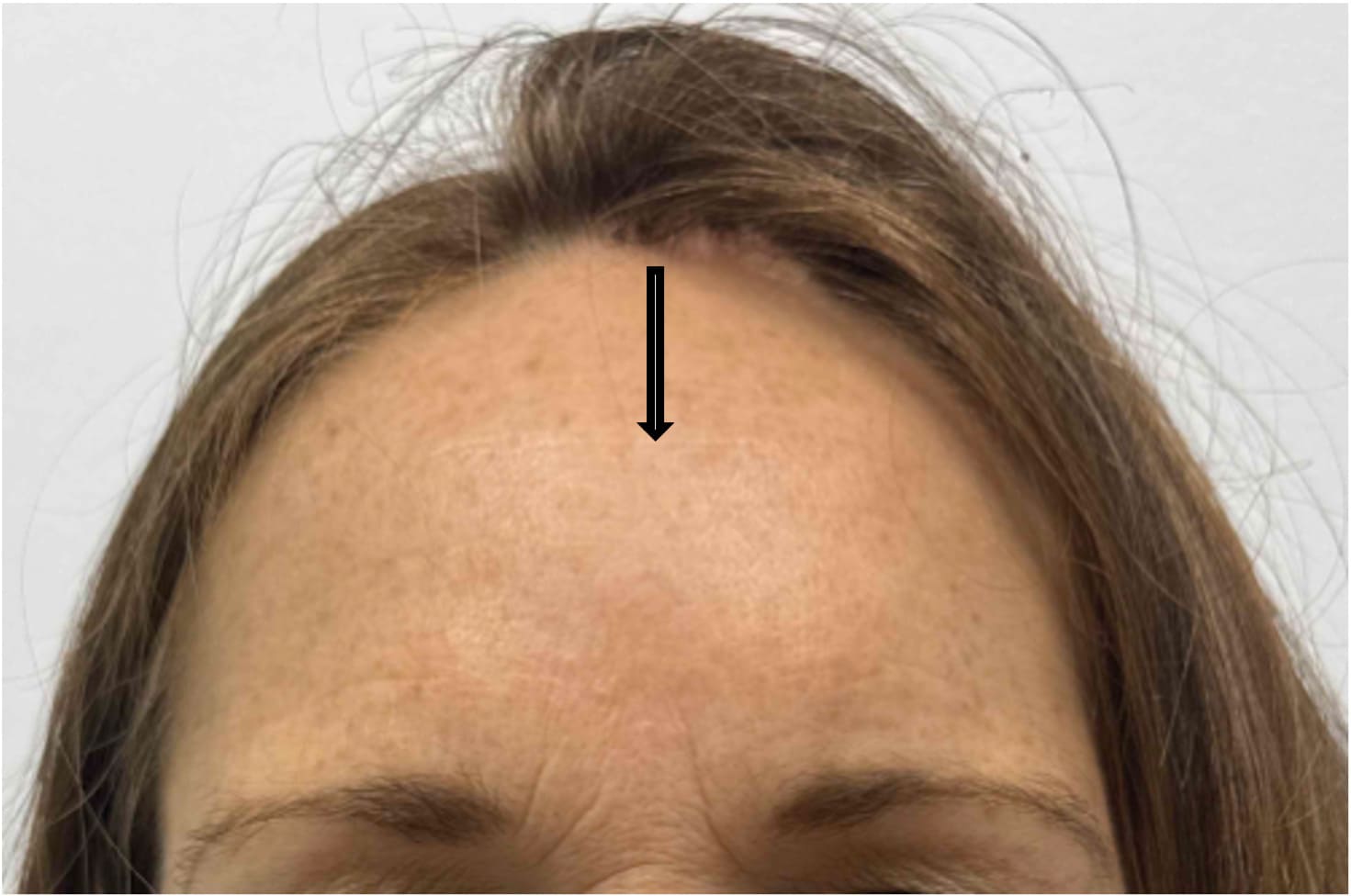 After osteoma removal showing a smoother forehead contour with a well-concealed incision, front view