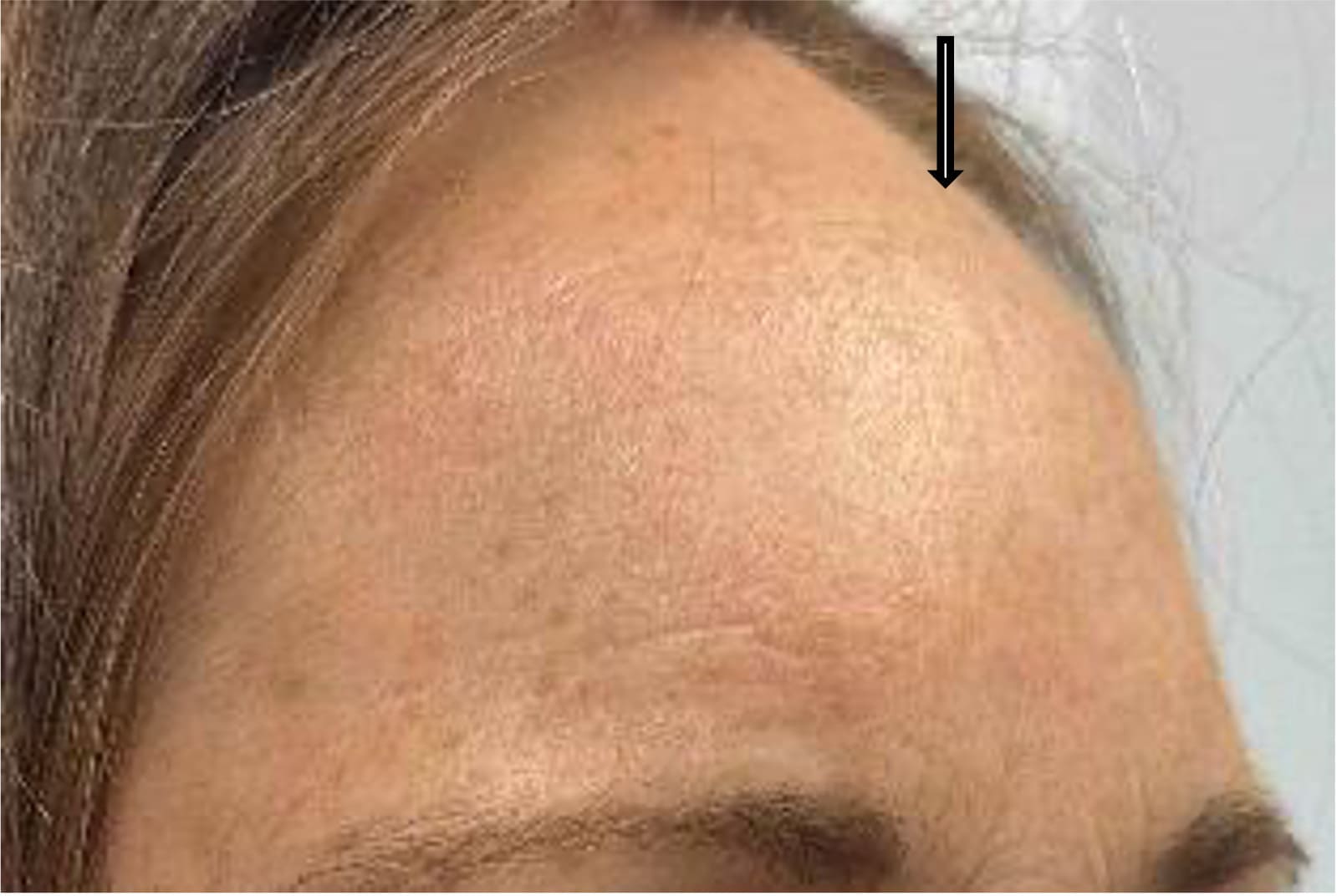 After osteoma removal showing a smoother forehead contour with a well-concealed incision, right oblique view