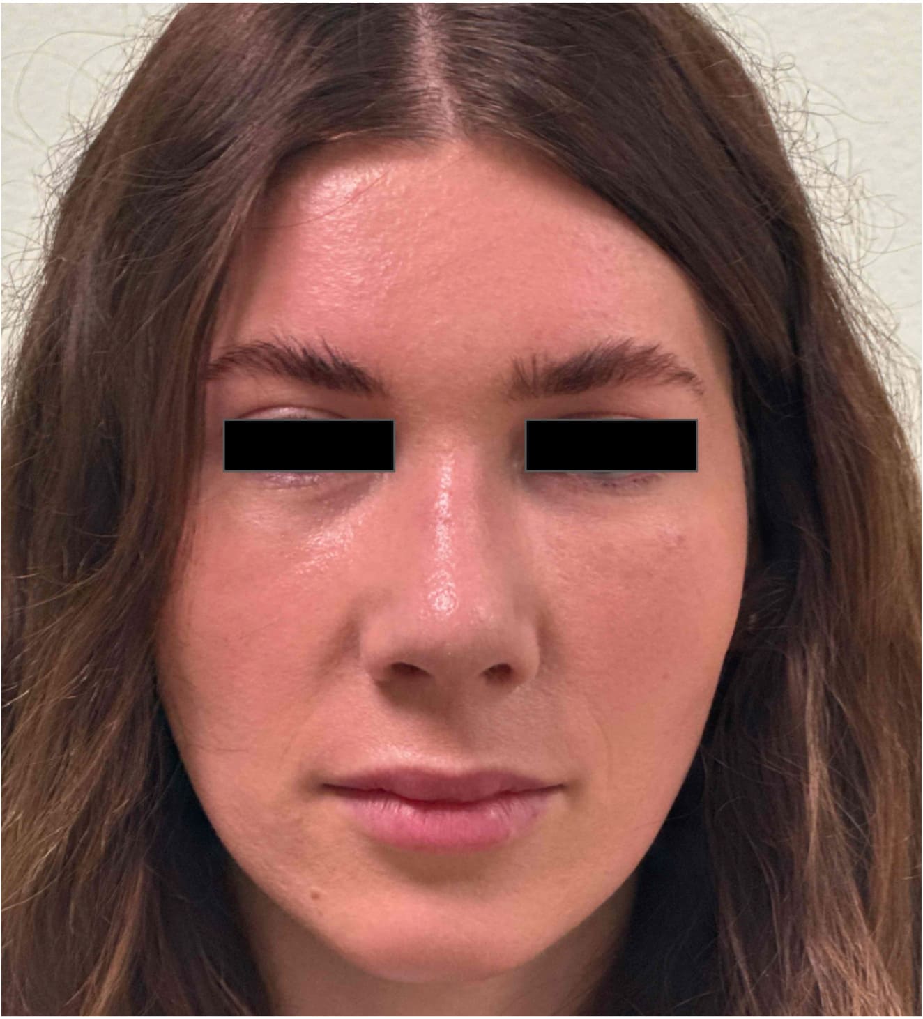 After rhinoseptoplasty showing improved nasal contour, septal correction, and enhanced facial harmony.