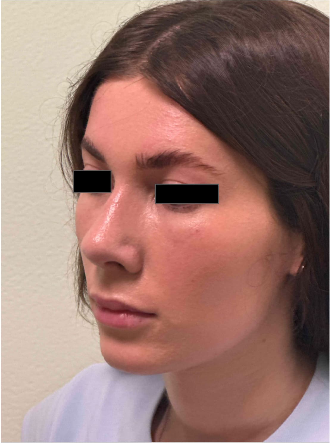 After rhinoseptoplasty showing improved nasal contour, septal correction, and enhanced facial harmony, left oblique view
