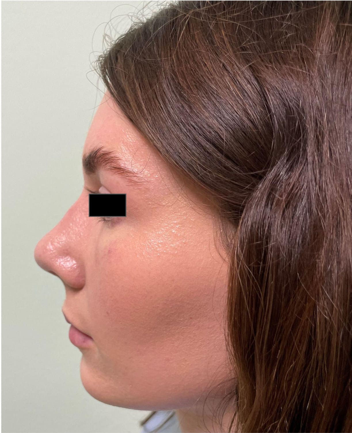 After rhinoseptoplasty showing improved nasal contour, septal correction, and enhanced facial harmony, left side view