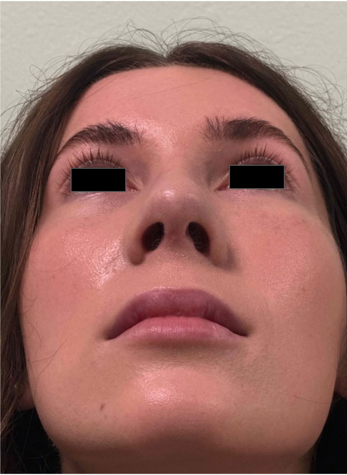 After rhinoseptoplasty showing improved nasal contour, septal correction, and enhanced facial harmony, base view