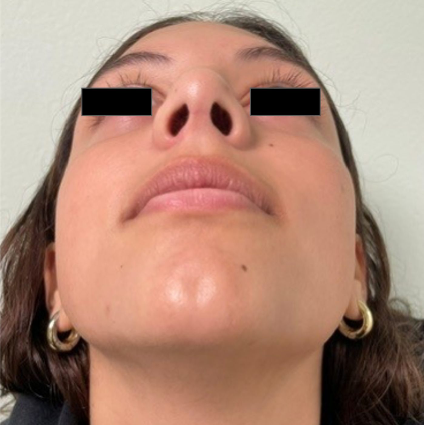After rhinoseptoplasty showing improved nasal symmetry and facial balanc, base view