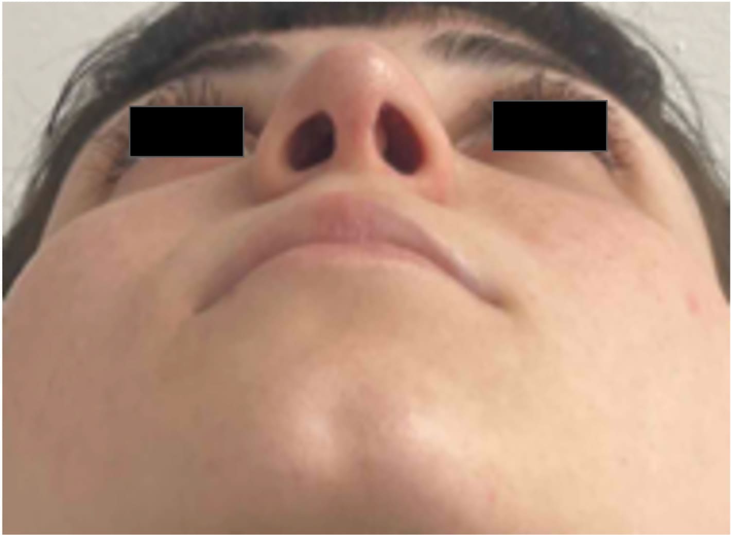 After rhinoseptoplasty showing improved nasal shape and facial harmony, base view