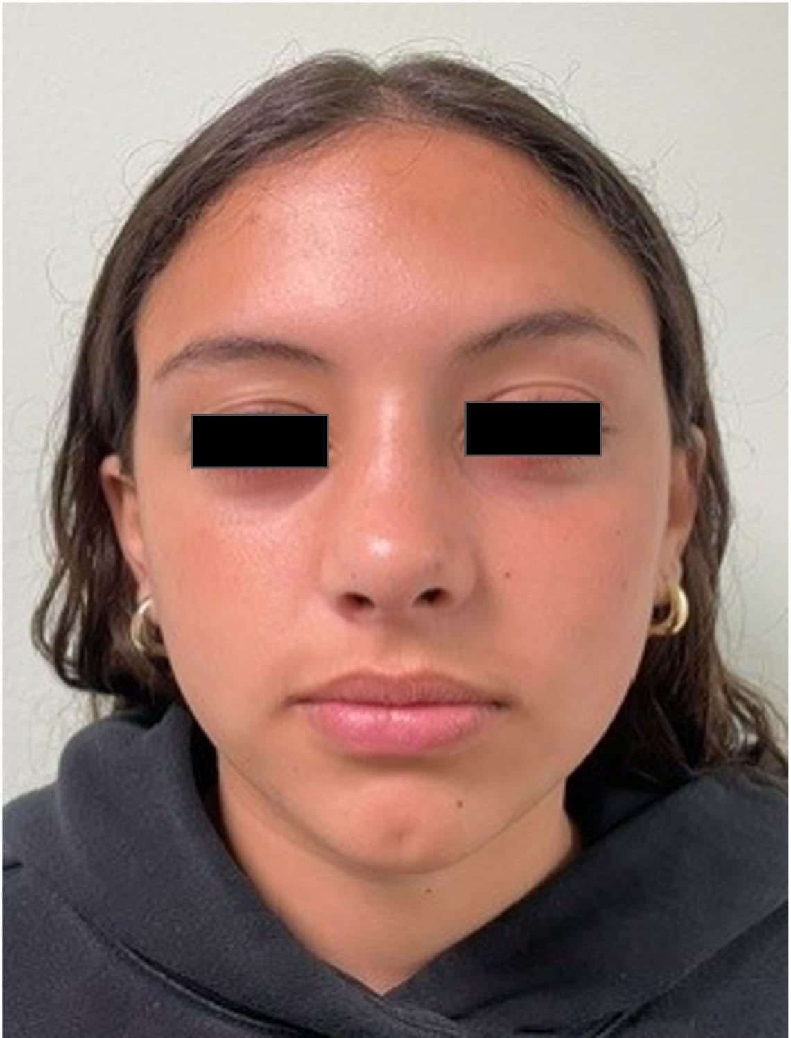 After rhinoseptoplasty showing improved nasal symmetry and facial balance, front view