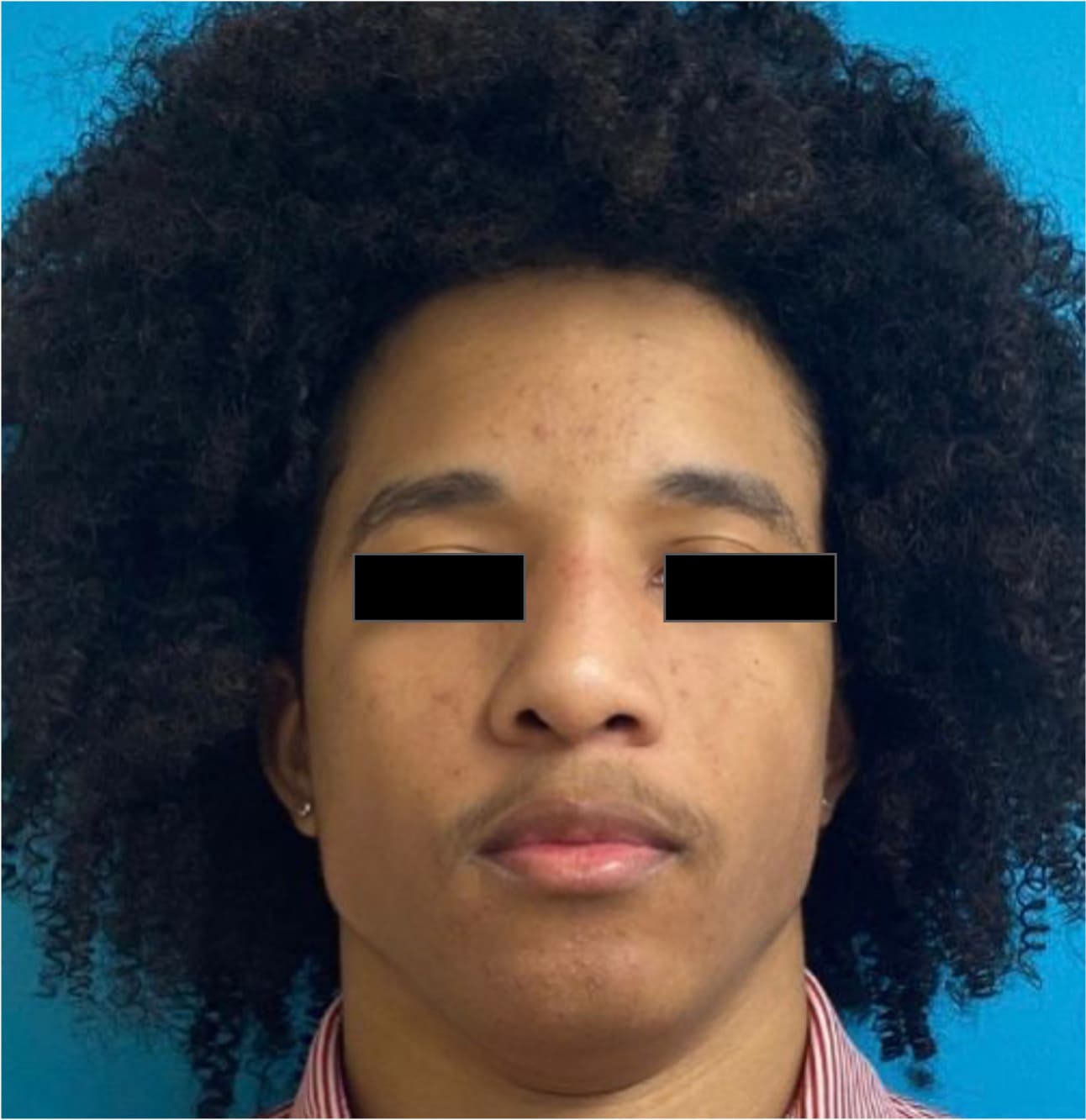 After rhinoseptoplasty showing improved nasal shape and facial harmony, front view