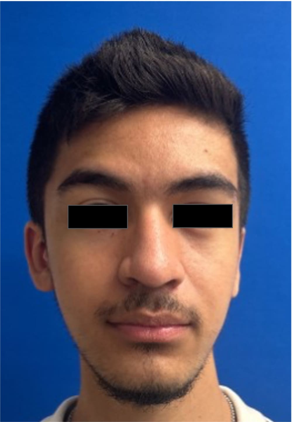 After rhinoseptoplasty showing improved nasal shape and facial harmony, front view