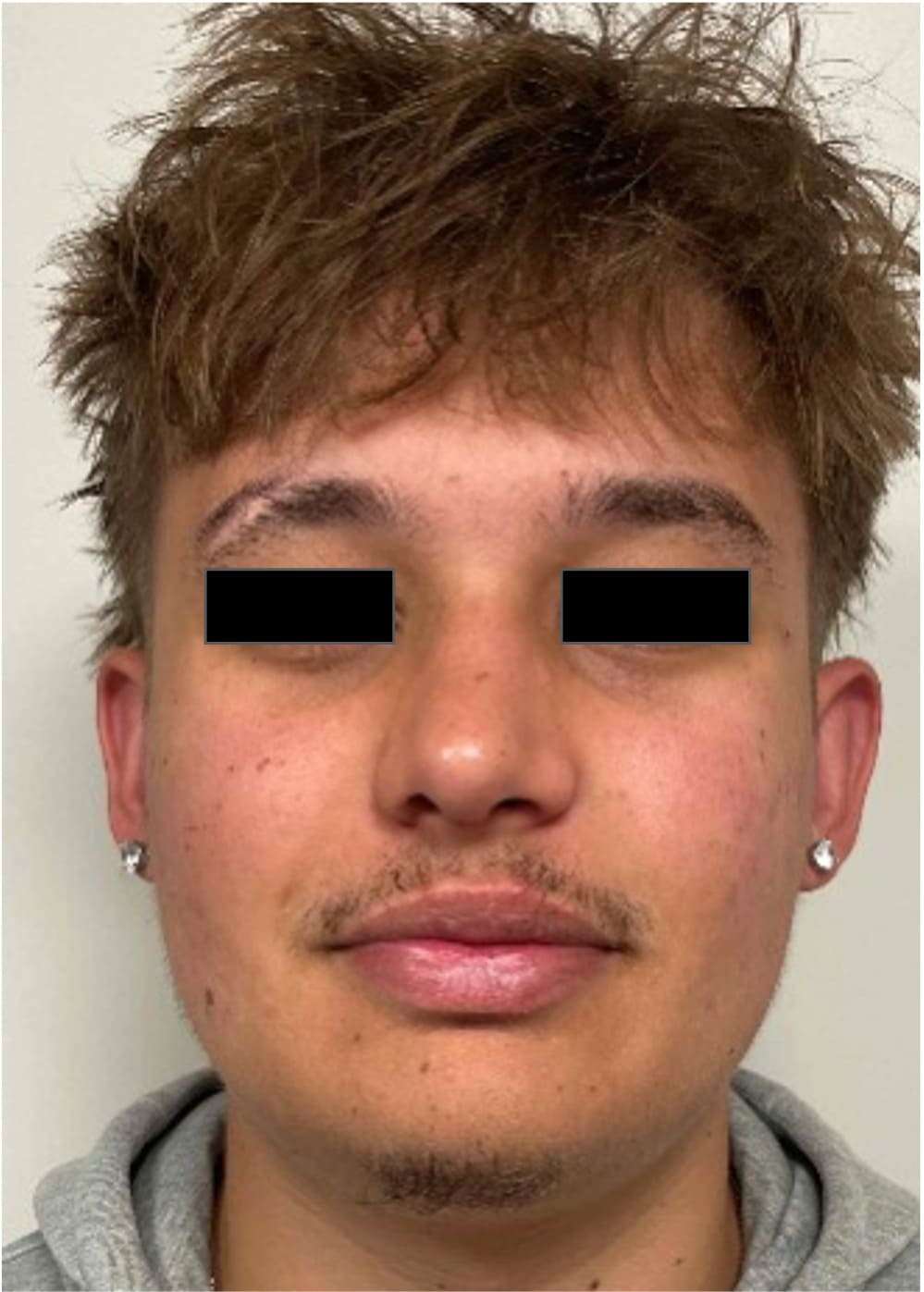 After rhinoseptoplasty showing improved nasal shape and facial harmony, front view