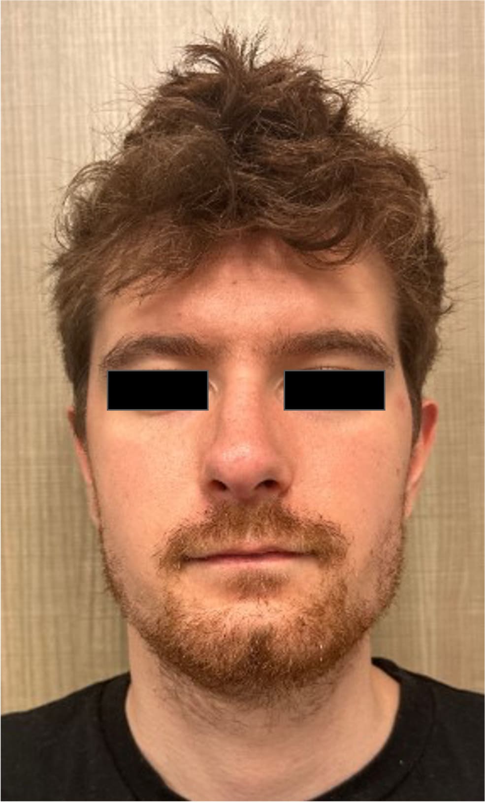 After rhinoseptoplasty showing improved nasal shape and facial harmony, front view