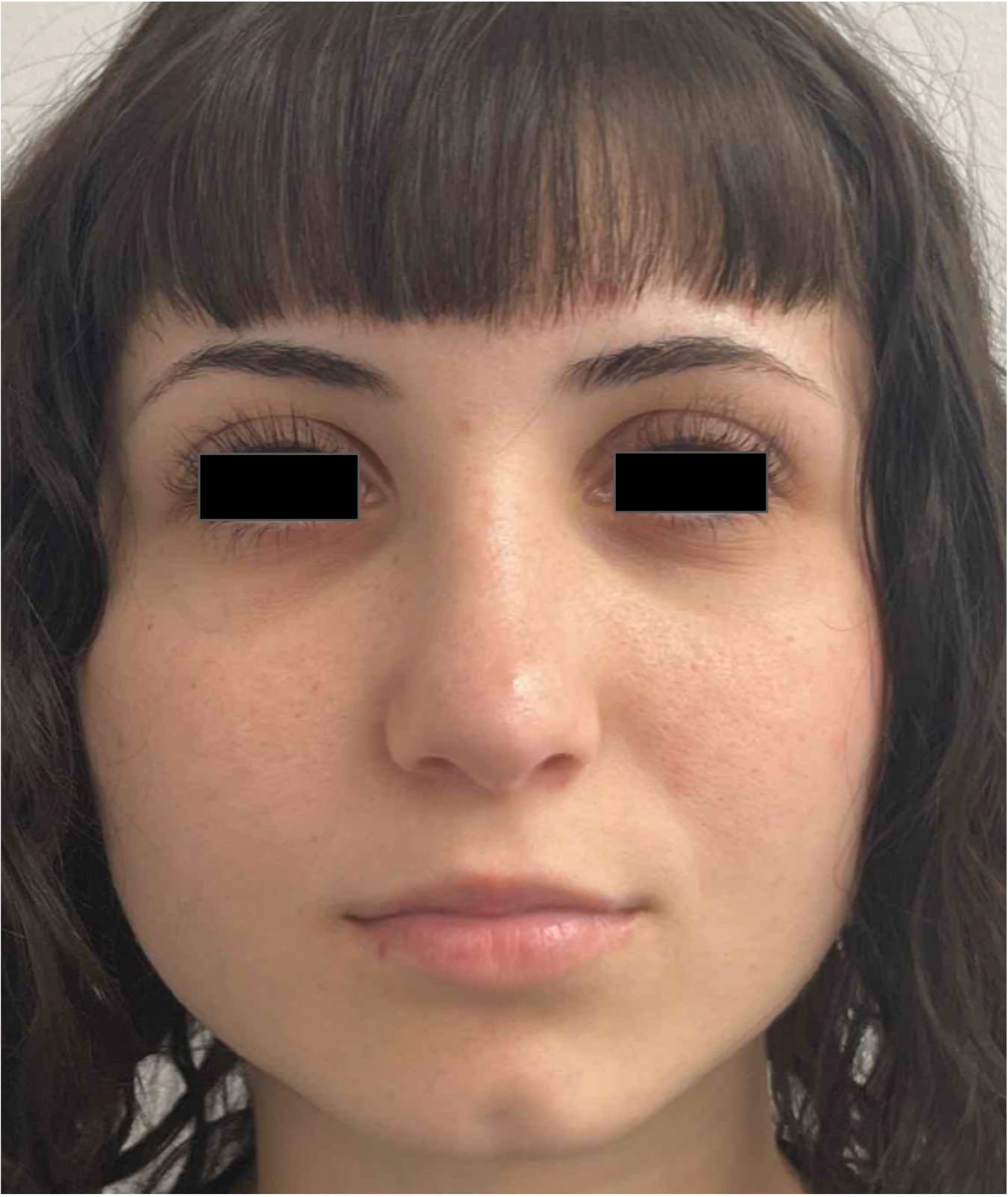 After rhinoseptoplasty showing improved nasal shape and facial harmony, front view