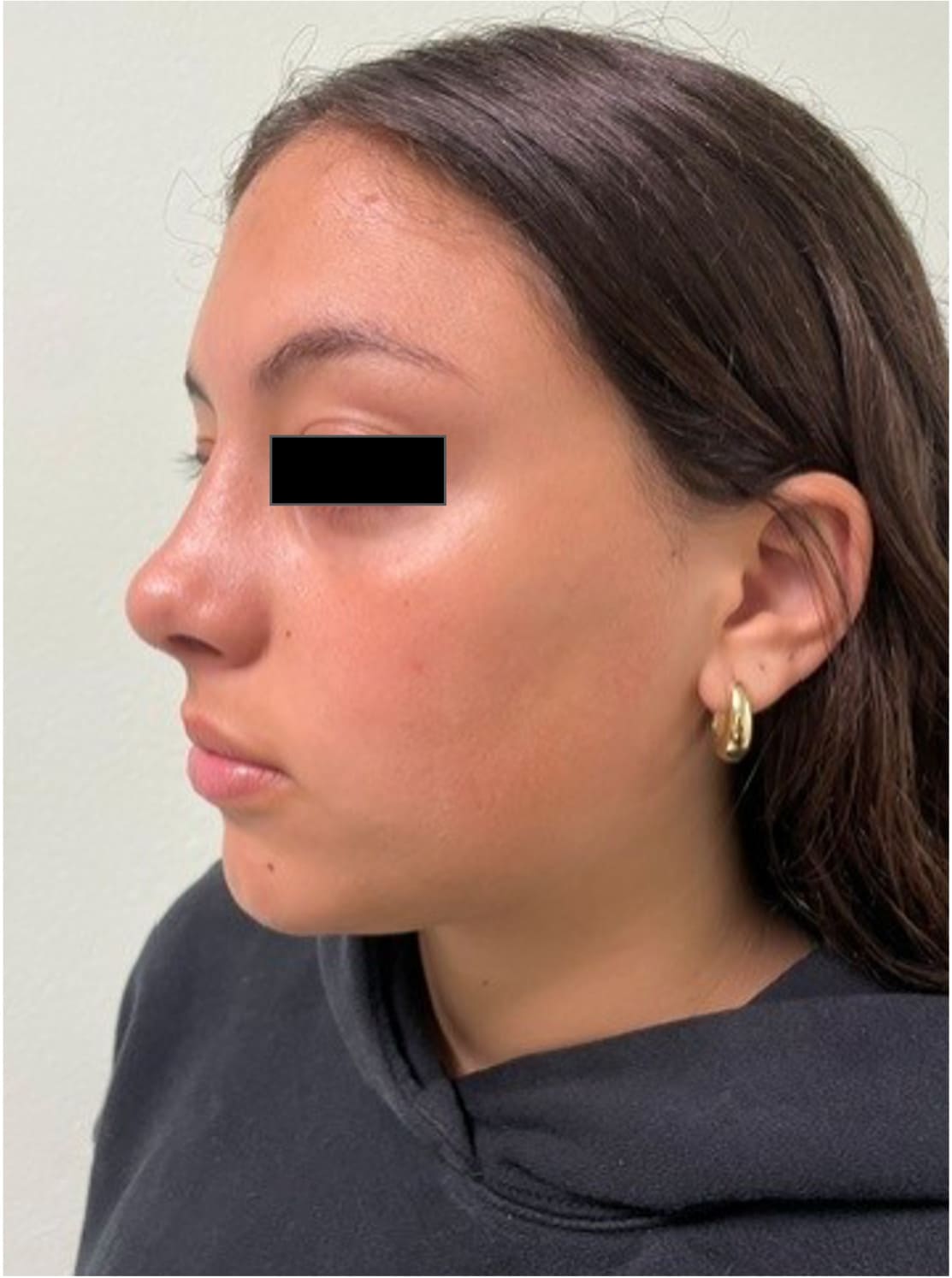After rhinoseptoplasty showing improved nasal symmetry and facial balance, keft oblique view