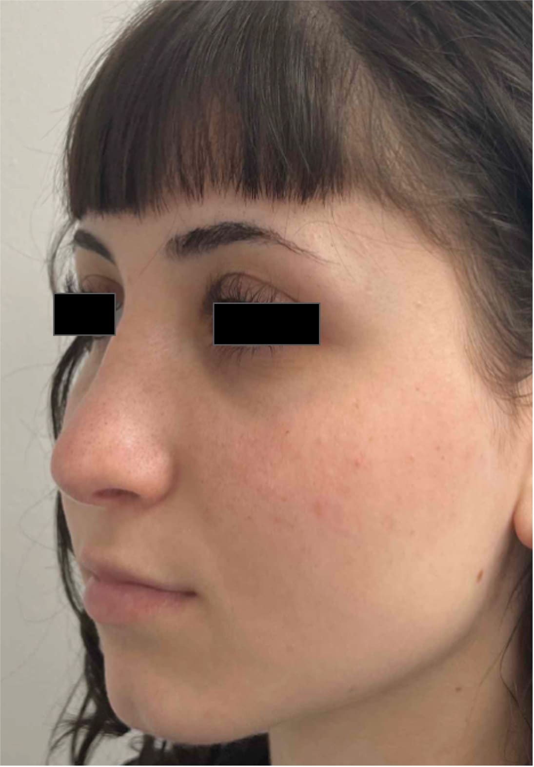 After rhinoseptoplasty showing improved nasal shape and facial harmony, left oblique view