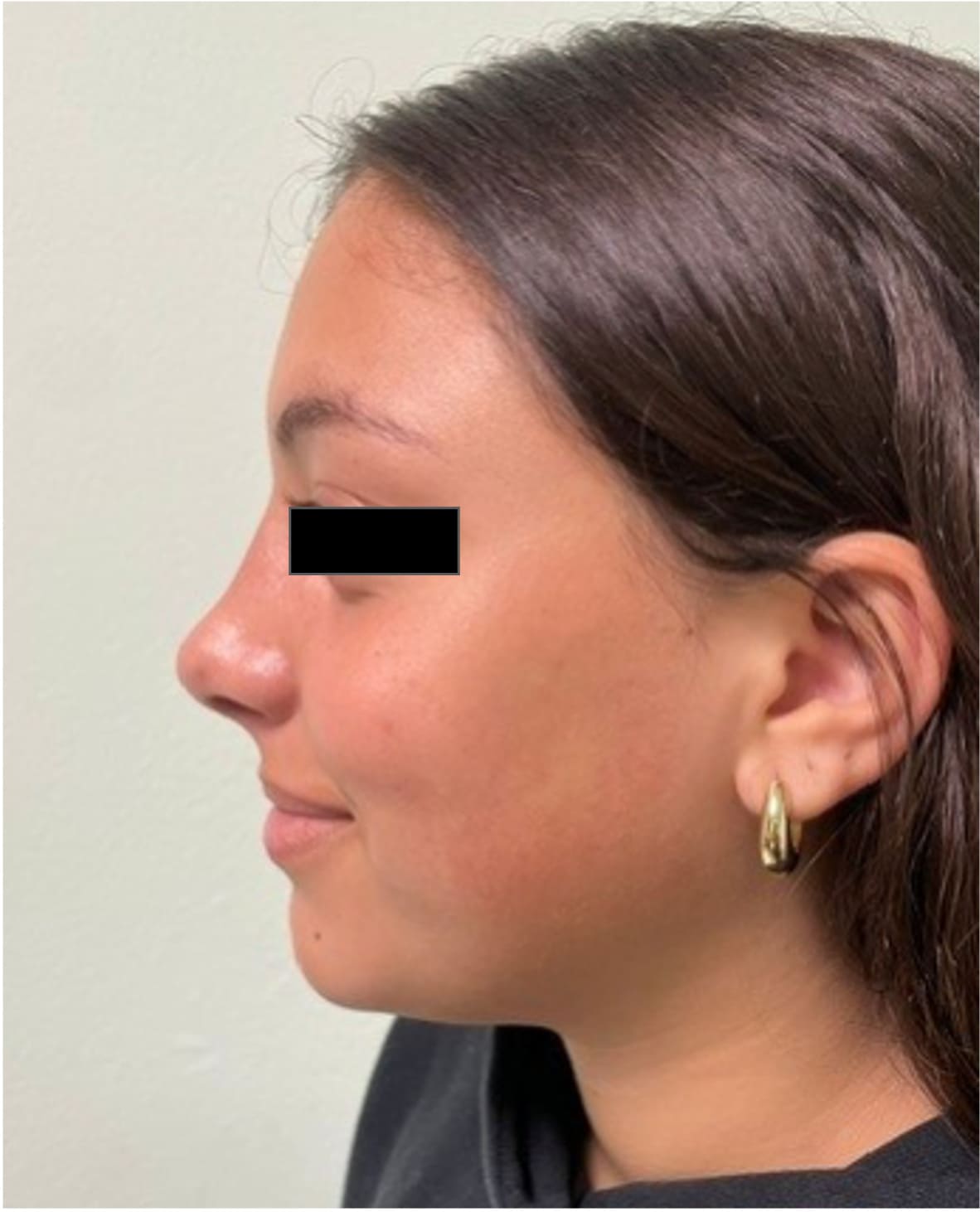 After rhinoseptoplasty showing improved nasal symmetry and facial balance, left side view