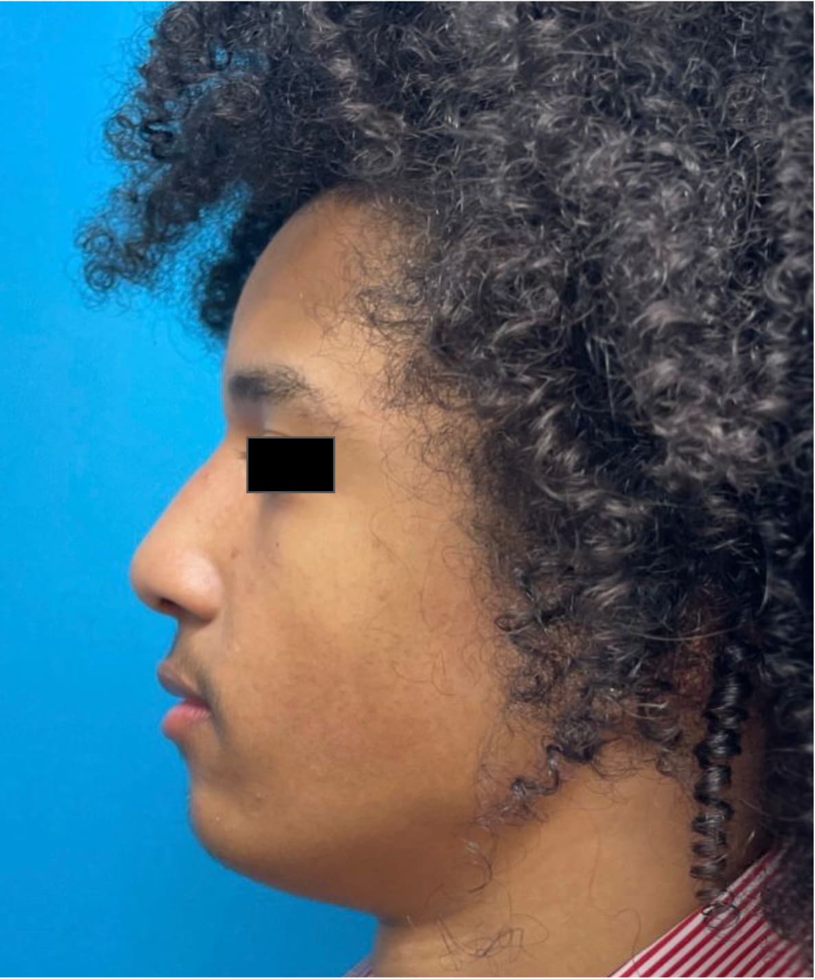 After rhinoseptoplasty showing improved nasal shape and facial harmony, left side view