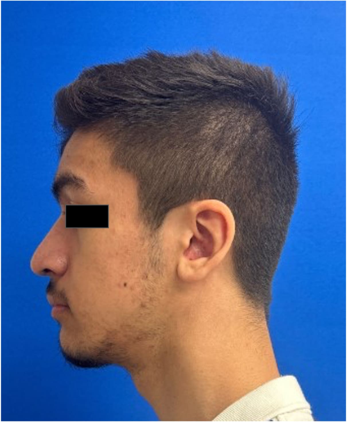 After rhinoseptoplasty showing improved nasal shape and facial harmony, left side view