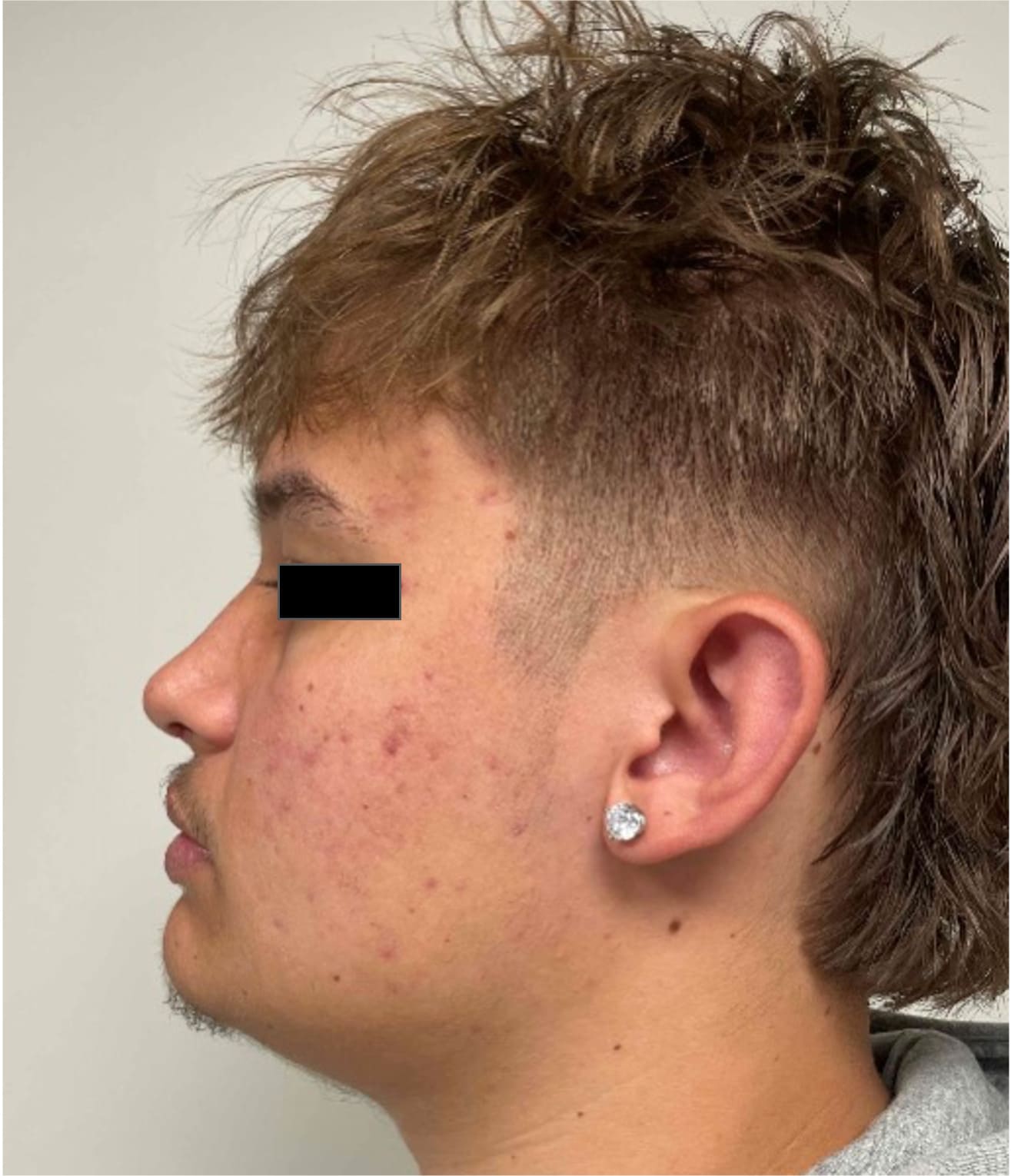 After rhinoseptoplasty showing improved nasal shape and facial harmony, left side view