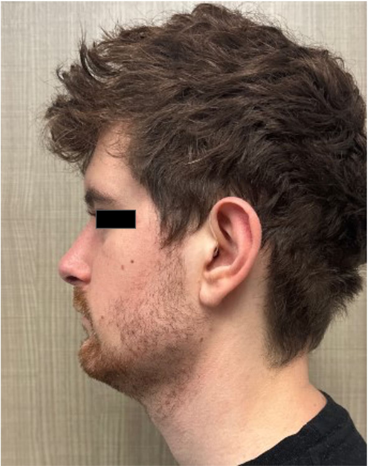 After rhinoseptoplasty showing improved nasal shape and facial harmony, left side view