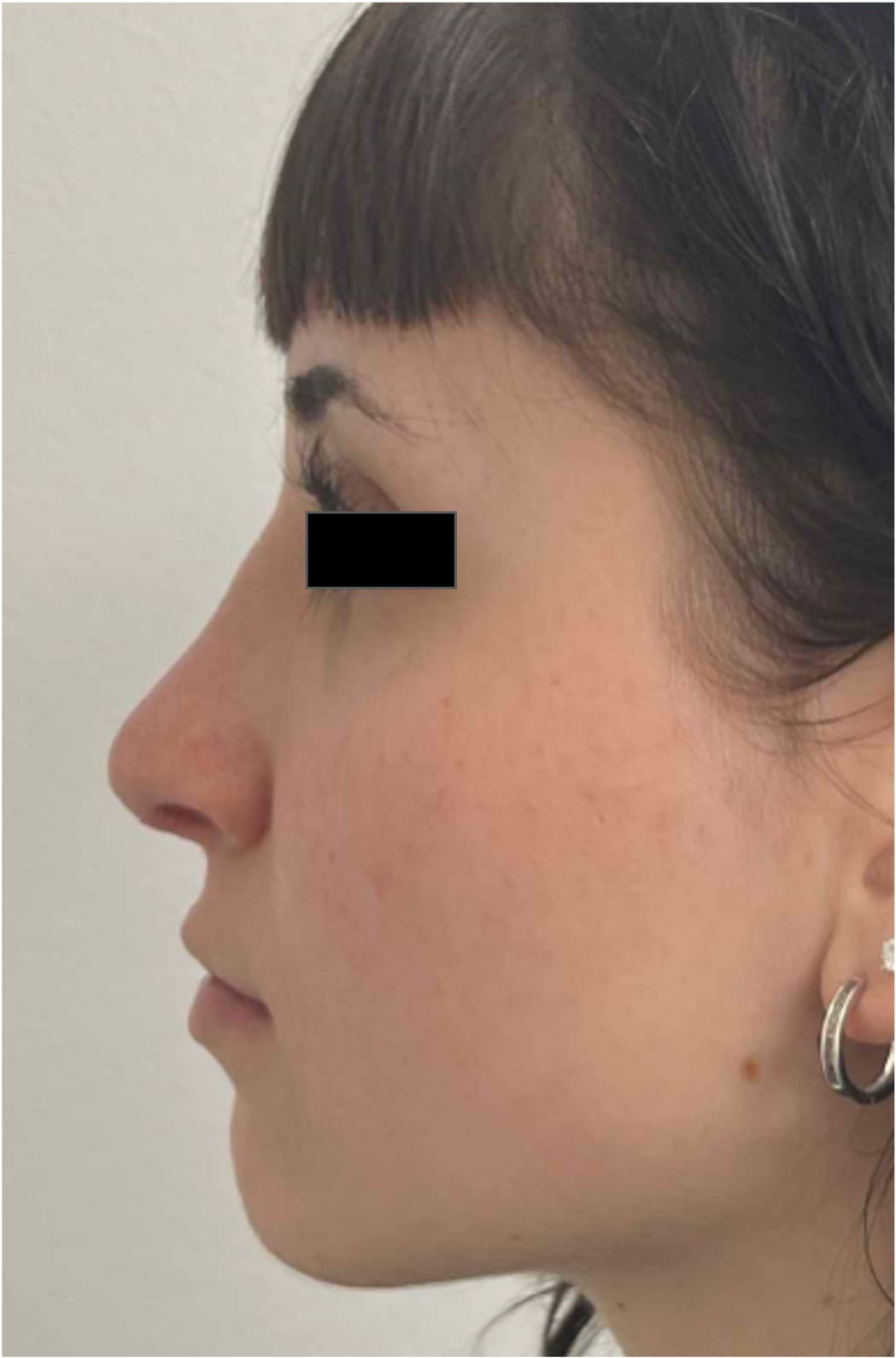 After rhinoseptoplasty showing improved nasal shape and facial harmony, left side view