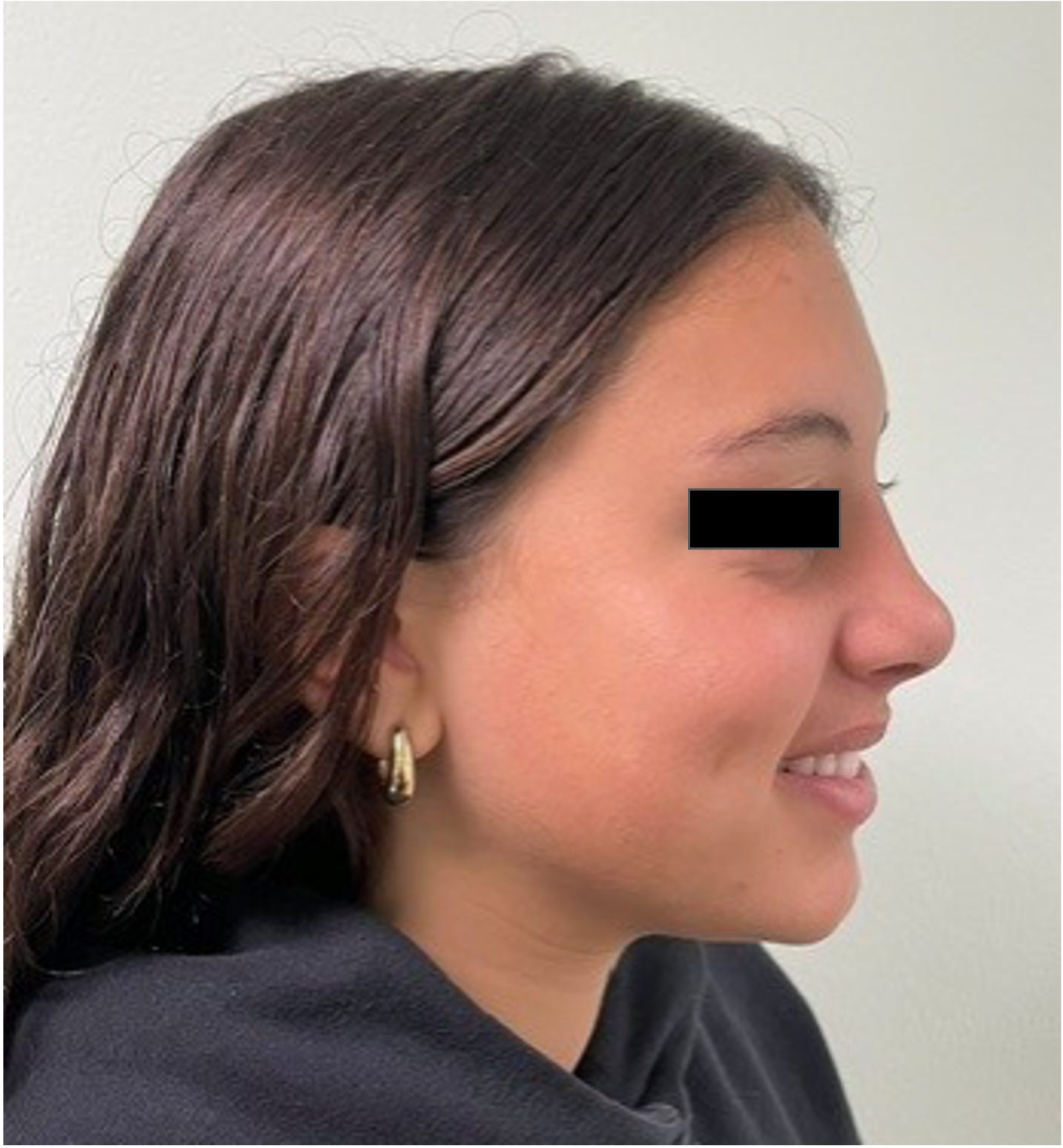 After rhinoseptoplasty showing improved nasal symmetry and facial balance, right oblique view