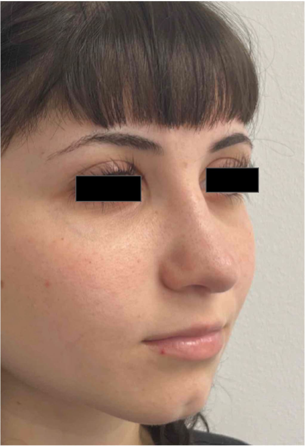 After rhinoseptoplasty showing improved nasal shape and facial harmony, right oblique view