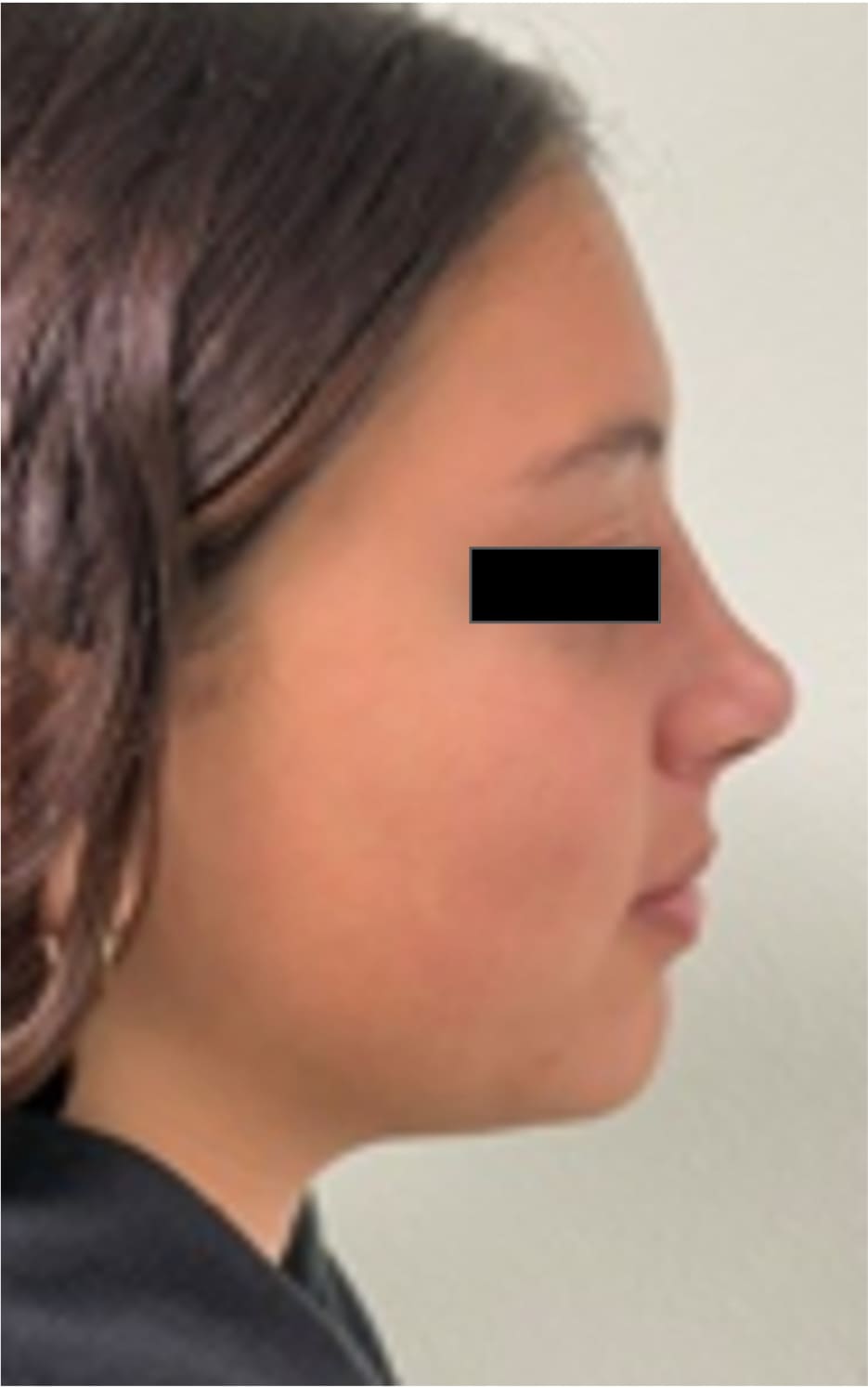 After rhinoseptoplasty showing improved nasal symmetry and facial balance, right side view
