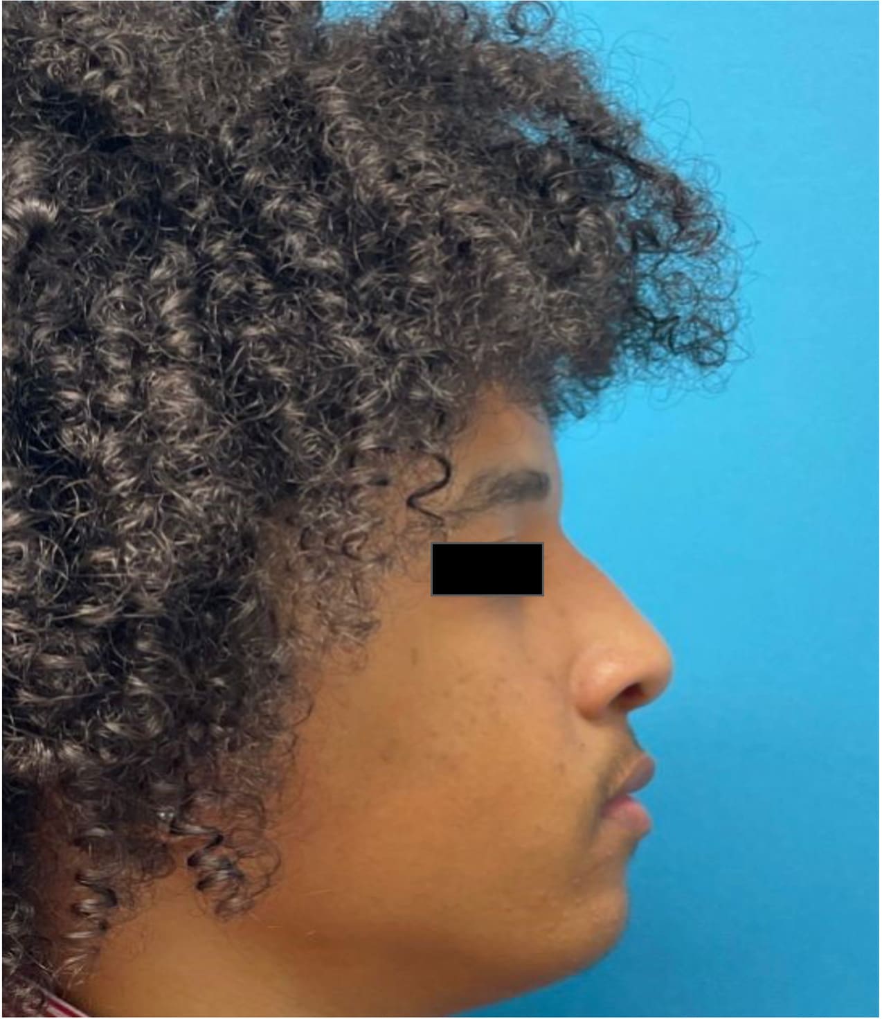 After rhinoseptoplasty showing improved nasal shape and facial harmony, right side view