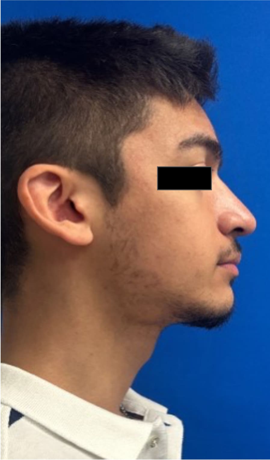 After rhinoseptoplasty showing improved nasal shape and facial harmony, right side view