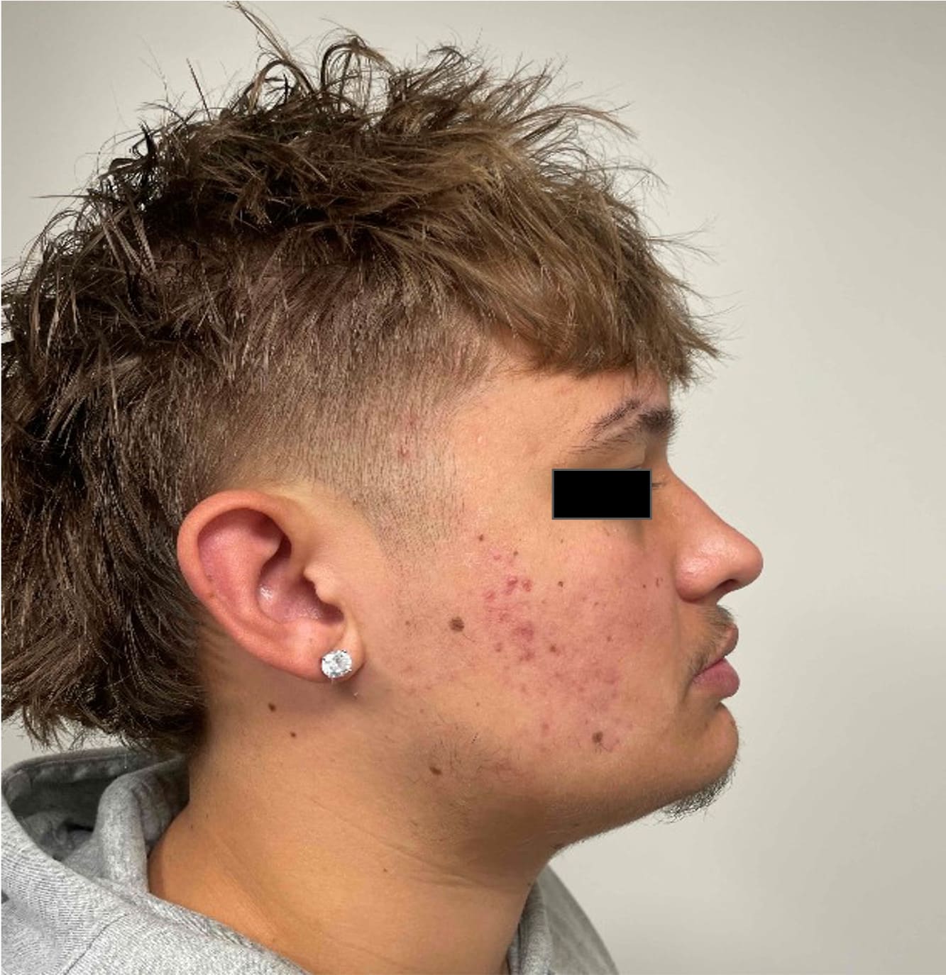 After rhinoseptoplasty showing improved nasal shape and facial harmony, right side view
