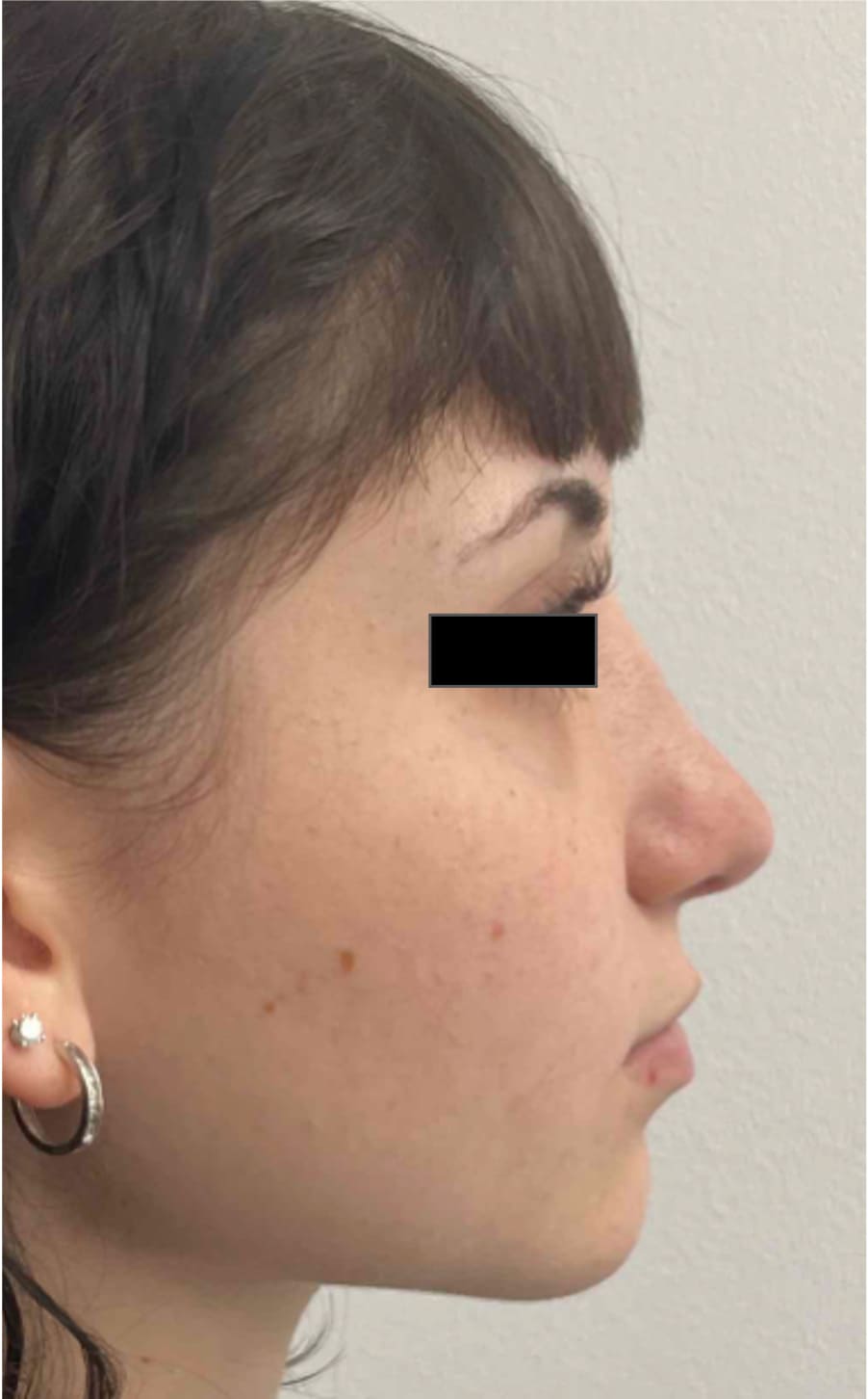 After rhinoseptoplasty showing improved nasal shape and facial harmony, right side view