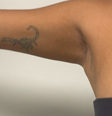 After right axillary breast tissue removal showing a smoother natural axillary contour with minimal scarring.
