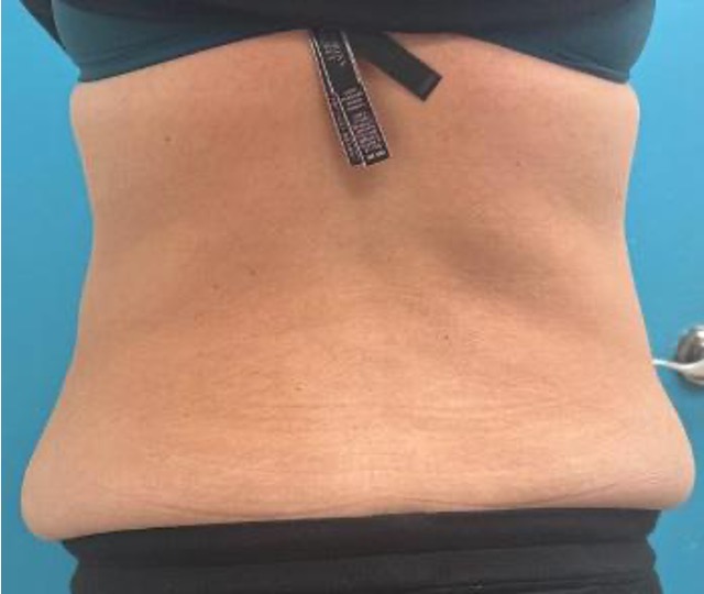 Before abdominoplasty showing abdominal fullness and excess skin, posterior view